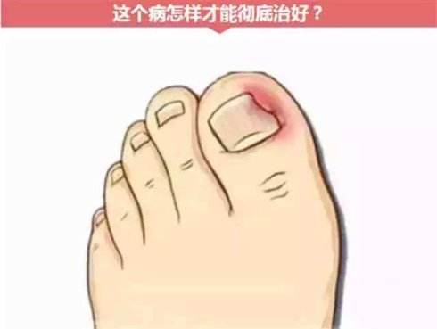 得了灰指甲该如何治疗?
